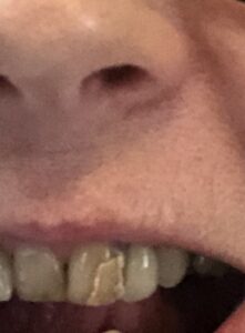 alt="tooth with repair"