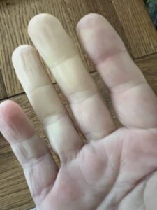 alt="white fingers going numb due to reynauds disease"
