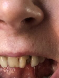 alt="mouth with broken tooth"